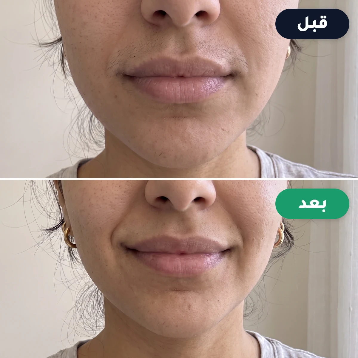 قبل وبعد خيطة: شعيرات الشفة العلوية قبل الاستخدام، وبشرة ناعمة بعده
